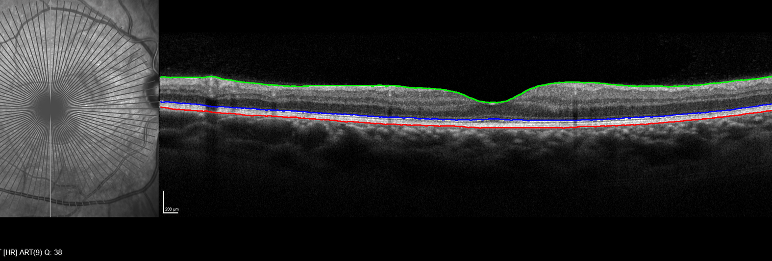 Steps of the OCT pipeline, from layer segmentation to the fitted 3D model.